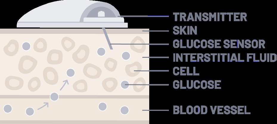 如何使用動態血糖監測設備(CGM)管理糖尿病 如何使用動態血糖監測設備(CGM)管理糖尿病